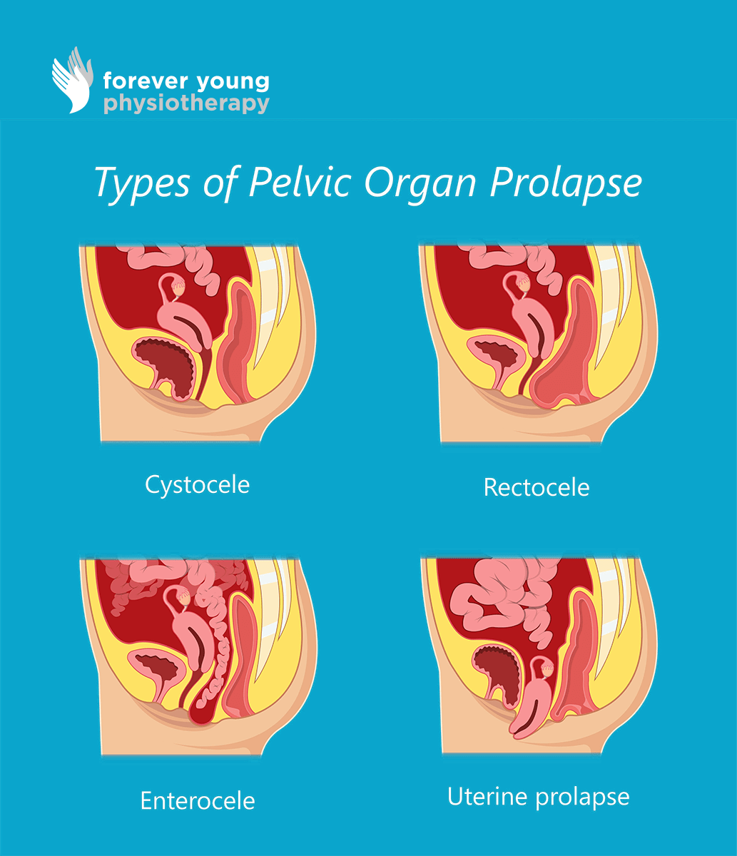 Types of Pelvic Organ Prolapse